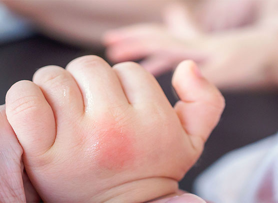 Puntura di insetto sulla mano del bambino